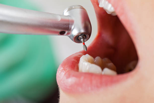 Best Emergency Tooth Extraction in Johnson City, TX